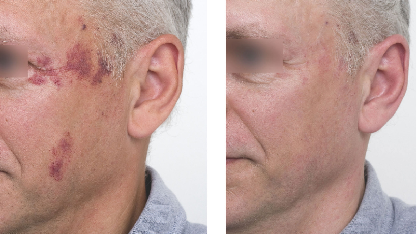 The latest in facial laser